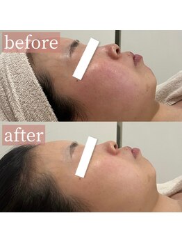 アディクトウラ(Addict'ula)/ラミネーションピール