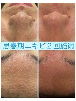 クラティス(CRATIS)/思春期ニキビ