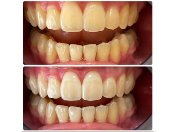 グリッター ショウナン(glitter. SHONAN)/歯のホワイトニングbefore/after