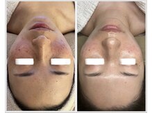 美しぐれ 溝の口店/【1ヶ月】LDM/LED/酸素ドーム