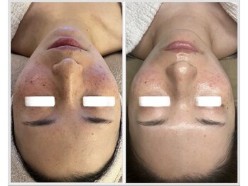 美しぐれ 溝の口店/【1ヶ月】LDM/LED/酸素ドーム