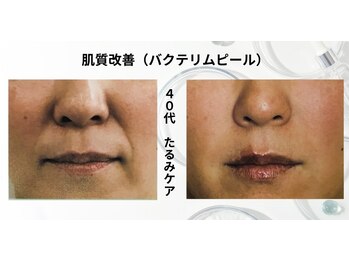 トレゾール(tresor)/★毛穴★40代（たるみ）