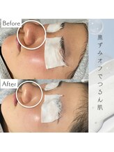 リアン(Lien)/【症例】毛穴ケアコース