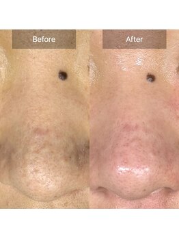 アウラ(Aula)/毛穴洗浄