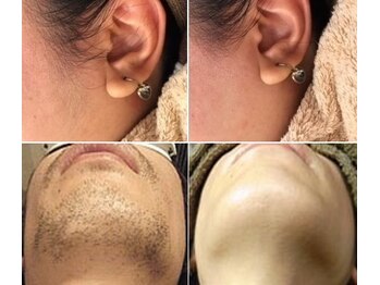 ナチュレアンドメディカ(Nature&Medica)/美療顔脱毛