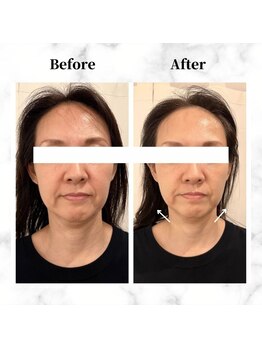 ザビューティー 麻布十番本店(The Beauty)/12Dリフト全顔打ち放題[リフト]