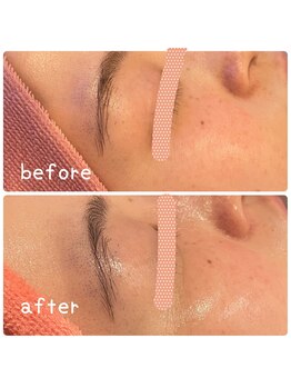 ヒメミ(Himemi)/BBL光エステ