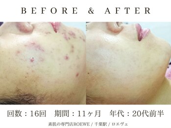 ロエヴェ(ROEWE)/ニキビ改善・毛穴ケア・肌質改善