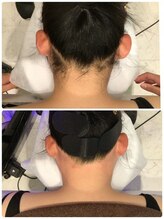 ビープラス(B plus)/うなじWAX脱毛で理想のうなじへ