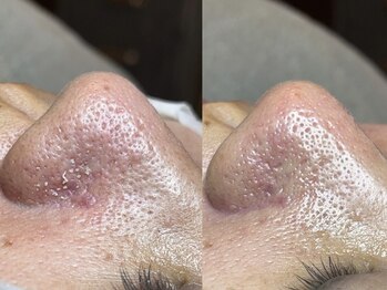 エヌエクラ(N.eclat.)/鼻