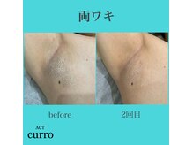 アクト クロ(ACT curro)/【両ワキ】脱毛施術例