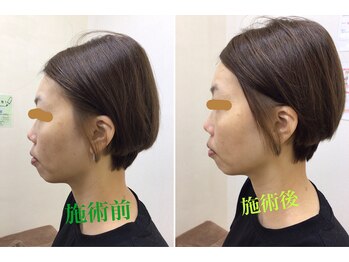 うちんだい整骨院 整体院/40代女性/小顔矯正 施術事例