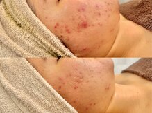 ニコレ(Nicore)/オーダーメイドハーブピーリング