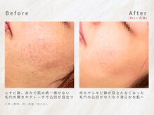 メレ(mele)/20代肌荒れ跡／ニキビケア・毛穴