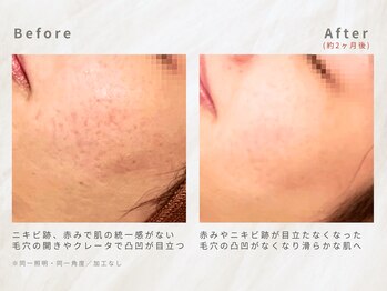 メレ(mele)/20代肌荒れ跡／ニキビケア・毛穴