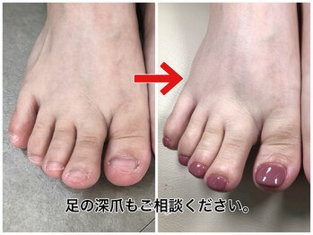 レアムネイル(Leam nail)/フットの深爪矯正も人気です！