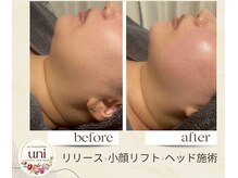 パーソナル ユニ(uni)/フェイスラインスッキリ小顔に！