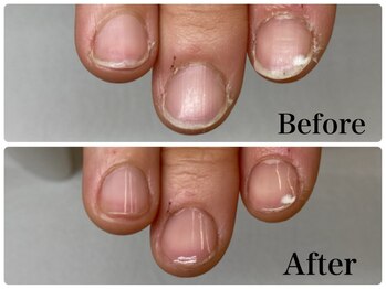 ネイルケア◇ビフォーアフター