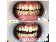 ルブラン 奈良店(Le Blanc)/2回で白く！！3回でさらに！