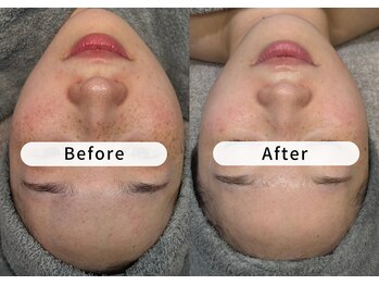 エミエル(EMIER)/ハーブピーリングBefore→After