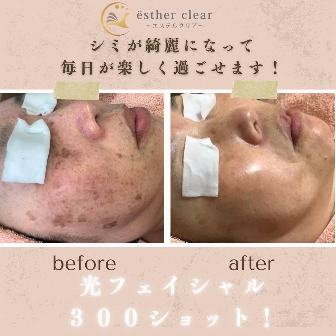 エステルクリア(esther clear)|ホットペッパービューティー