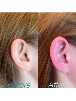 イトミミ(いとみ3)/施術前→施術後