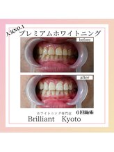 ブリリアント 京都店(Brilliant)/プレミアムホワイトニング