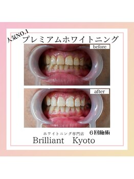 ブリリアント 京都店(Brilliant)/プレミアムホワイトニング
