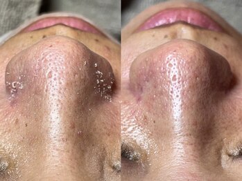 エヌエクラ(N.eclat.)/鼻