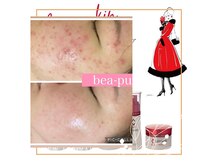 ビパール(bea pull)の雰囲気（肌悩み別ハーブピーリング　繰り返しニキビケア）