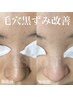 【毛穴改善/ハリ艶UP】毛穴エクストラクションプロ　¥13000→¥11000