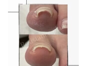 ミヨン 喜多見店(Miyong)/巻き爪