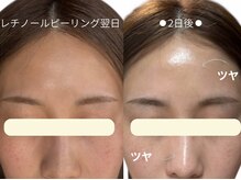 ボン セジュール(Bon sejour)/レチノールララピール