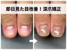 【深爪/噛み爪/むしり爪】長さを出して即日見た目改善！深爪矯正初回￥21000→