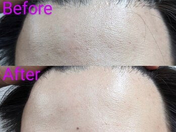 柏の葉オレンジ整体院/☆★プラズマ幹細胞美顔★☆