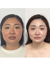 【丸顔】30代女性×骨格のせいかも？ダイエットしても変わらない輪郭に