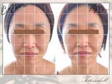 トーティシェル(tortoise shell)/施術を受けるたびに…