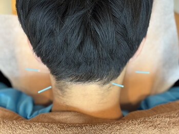 千葉寺ありがとう整骨院/鍼灸施術風景