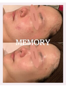 メモリー(MEMORY)/ニキビ、毛穴にアプローチ！