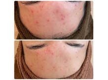 ウェリナベル(WelinaBelle)の雰囲気（無添加ハーブピーリング肌に優しく働き繰返すニキビ改善毛穴レス）