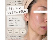 マロン(MARON)の雰囲気（本格肌質改善/ハーブピーリング/大人ニキビケア）