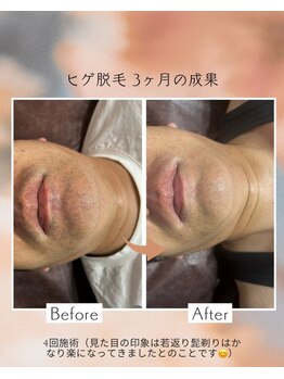 オフ(off)/ヒゲ脱毛