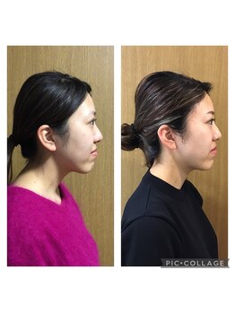 マカニ 河原町御池(makani)/小顔矯正ビフォーアフター