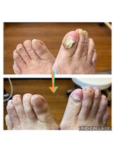 Dr.ネイル爪革命 静岡沼津店/爪切り・肥厚爪ケア