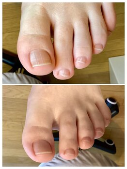 ドクターネイル爪革命 麻布十番店/【足の爪切り】フットケア