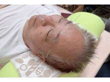 命水鍼灸院/眼精疲労【新宿/鍼灸】