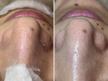 エヌエクラ(N.eclat.)/鼻