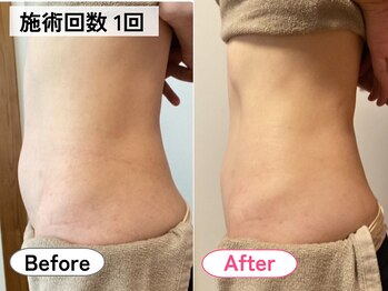 ハロ(Halo)/腸もみマッサージ・腸セラピー