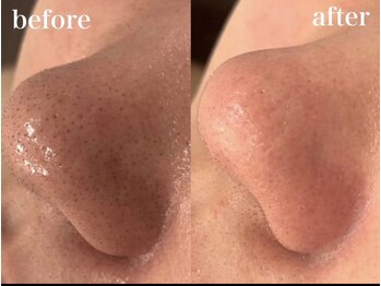 ホワイトアクア 京橋店(WHITE AQUA)/毛穴洗浄×引き締めケア