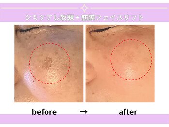 カピリナスパ(Ka.Pilina Spa)/シミケア2回目 before⇒after